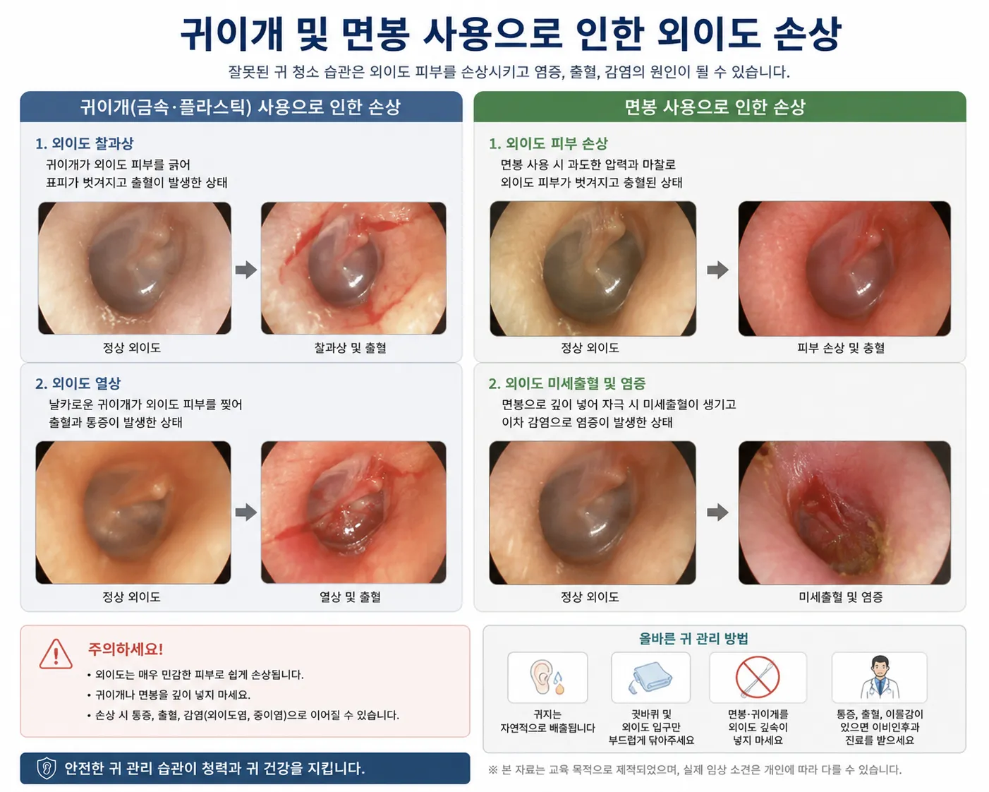 귀이개 및 면봉 사용으로 인한 외이도 손상 의학 사진 — 교육 목적