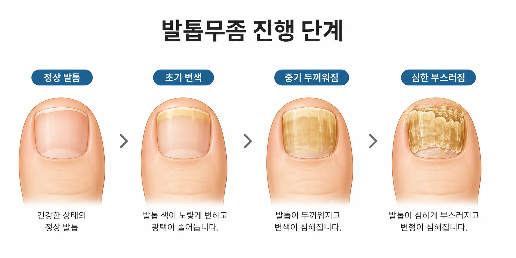 발톱무좀의 단계별 진행 — 정상 발톱부터 심한 감염 단계까지의 의학 일러스트