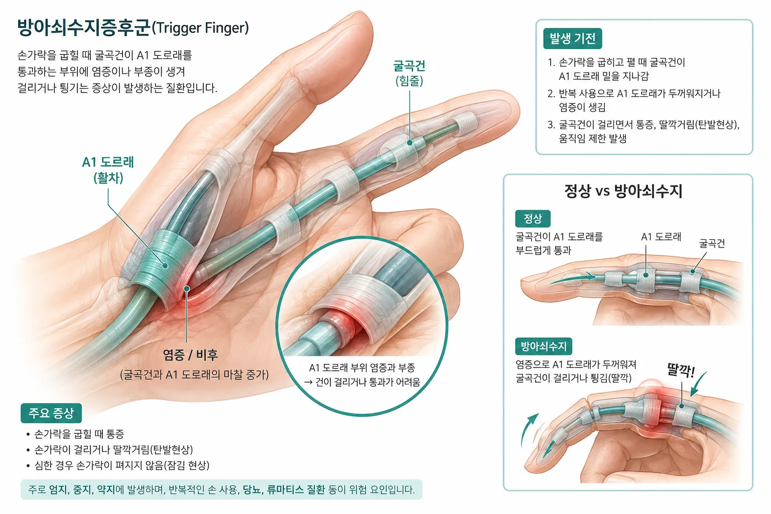 방아쇠수지증후군 설명 일러스트 – 손가락 굴곡건과 A1 도르래 주변 염증 구조를 보여주는 의학 그림
