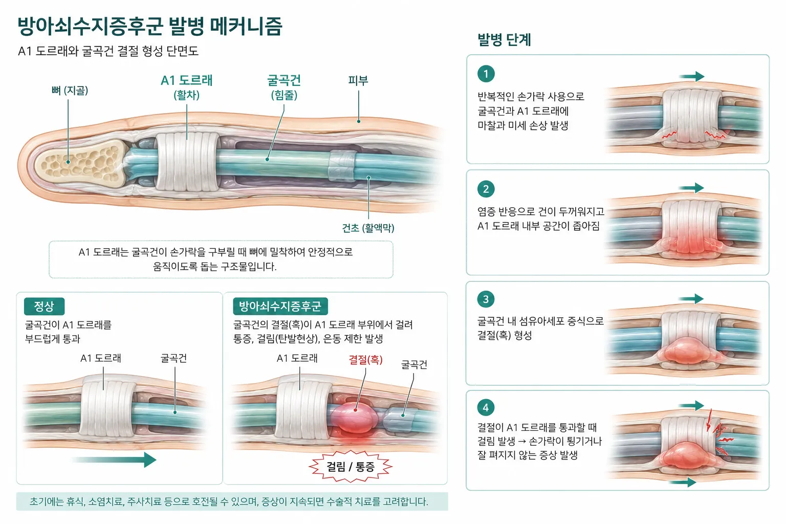 방아쇠수지증후군 발병 메커니즘 – A1 도르래와 굴곡건 결절 형성 단면도