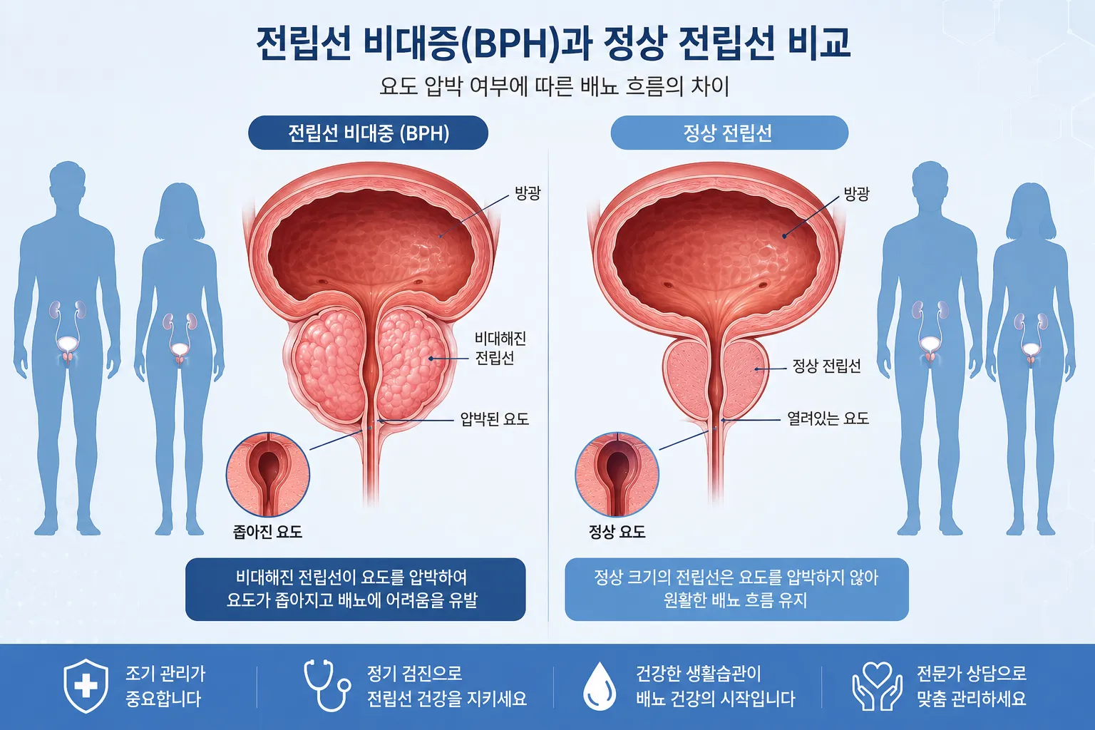 양성 전립선 비대증(BPH)으로 인한 요도 압박과 정상 요도를 비교하는 의학 해부 일러스트