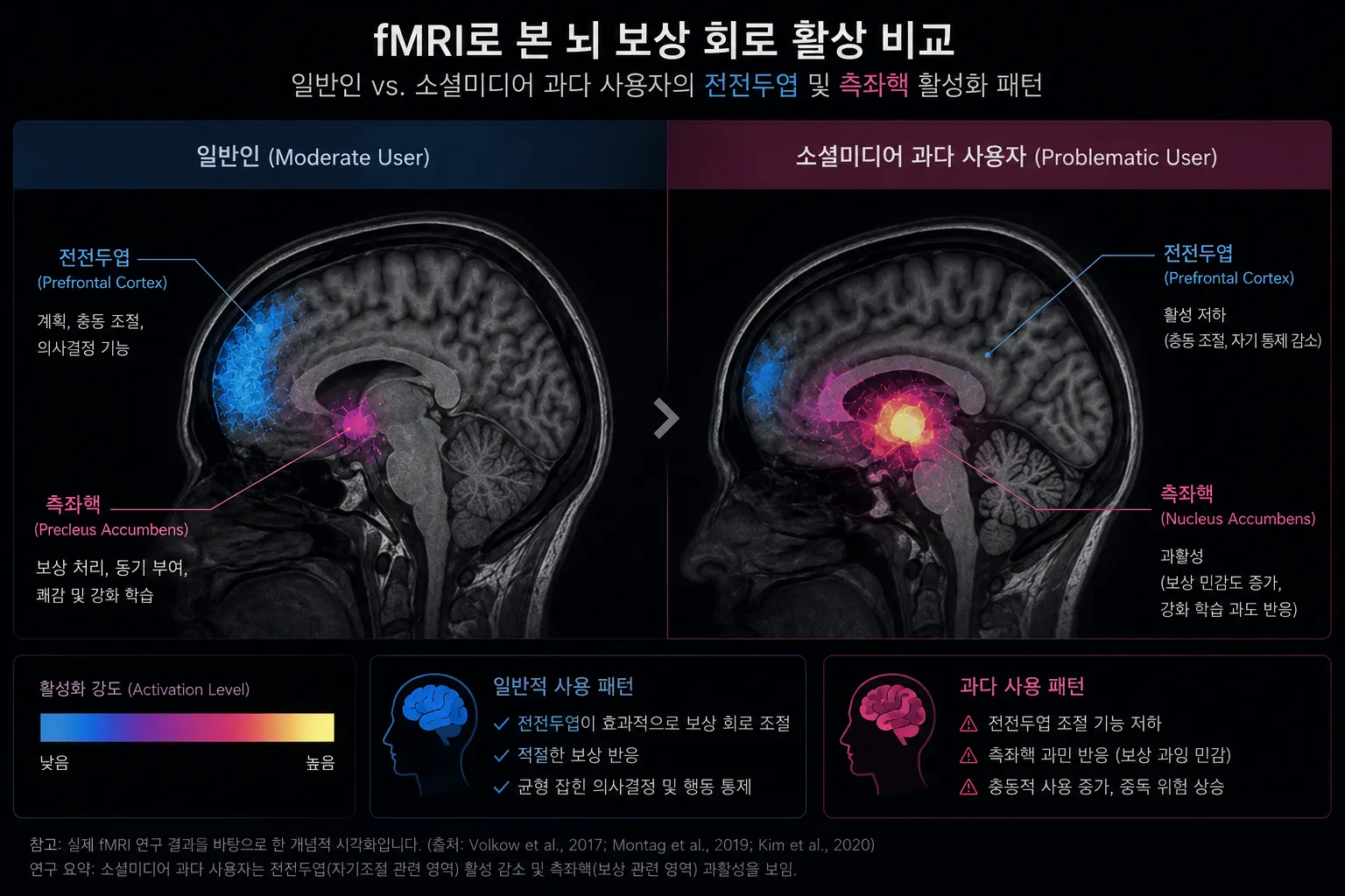 소셜미디어 과다 사용자와 일반인의 뇌 fMRI 스캔 비교 이미지 — 전전두엽 활성화 차이와 측좌핵 과반응 패턴 신경영상 비교 연구